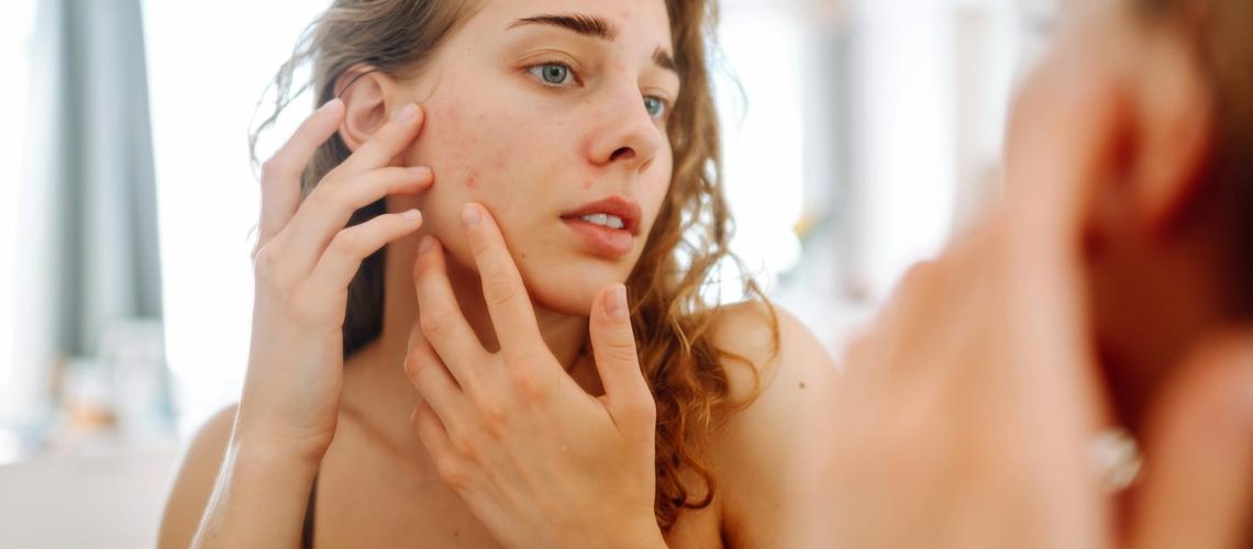 Quels sont les effets du soleil sur l'acné ? Est-il un ami ou un faux ami ?